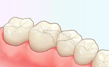 クラウン（被せもの）インレー（詰め物）