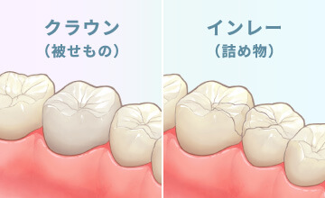 クラウン（被せもの）インレー（詰め物）