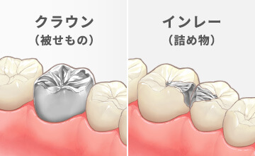 クラウン（被せもの）インレー（詰め物）