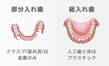 部分入れ歯（クラスプは金属のみ）総入れ歯（人工歯と床はプラスチック）