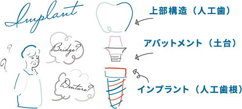 上部構造（人工歯）アバットメント（土台）インプラント（人工歯根）