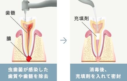 虫歯 根管治療 歯周病治療 診療案内 横浜市戸塚区の歯科 歯医者 和田歯科医院