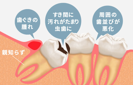 歯ぐきの腫れ・すき間に汚れがたまり虫歯に・周囲の歯並びが悪化