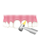 歯間や歯面をクリーニング