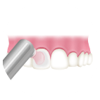 歯の表面をツルツルに仕上げ磨き
